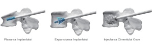 TRIPOD-FIX – Sistem Expandabil Vertebral pentru Fracturi de Compresie | Augmentare cu PMMA - Img 3