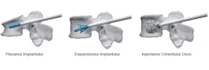 TRIPOD-FIX – Sistem Expandabil Vertebral pentru Fracturi de Compresie | Augmentare cu PMMA - Img 3