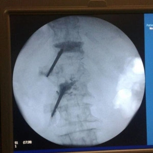 Vesta, Surub din Titan, fenestrat (Osteoporoza,  AP Trauma si Oncologie)