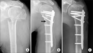 Placa Humerus Proximal poliaxiala pentru osteointeza fracturii de Humerus
