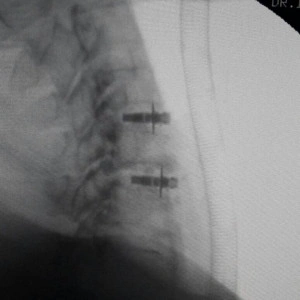 ARION – Cage Cervical Expandabil cu Lame de Fixare | Fuziune Anterioară Cervicală - Img 4
