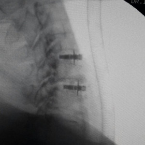 ARION EXPANDABLE BLADED CERVICAL PEEK CAGE - Img 4