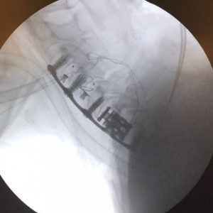 AURA, Suruburi fixare placa cervicala ( AP Trauma)