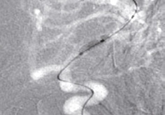 Cateter cu balon PTA pentru tratamentul stenozei intracraniene - NeuroSpeed® - Img 3