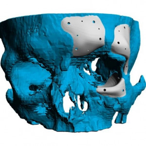 Cranioplasty plate for ENT defects - Img 2