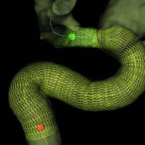 Dispozitiv de embolizare pentru tratamentul anevrismelor cerebrale - DERIVO® 2 - Img 2