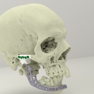 iCMF Ti – Implant Craniomaxilofacial Personalizat din Titan | BoneEasy®