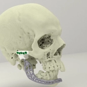 iCMF Ti – Implant Craniomaxilofacial Personalizat din Titan | BoneEasy®