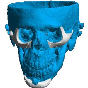 Implant personalizat pentru reconstructia fetei si craniului | 3di Germania - Img 3