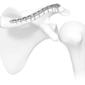 Placă Claviculă extremitate laterala – Tratament Fracturi Laterale | Sistem Vortex Sanatmetal