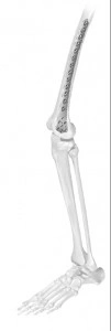 Placă de Femur Distal Vortex – Fixare Poliaxială