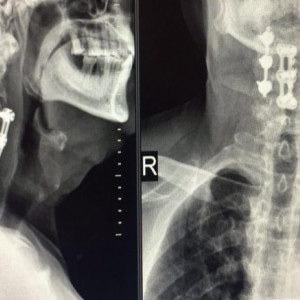 PORTHOS POSTERIOR CERVICAL SPINAL FIXATION SYSTEM - Img 6