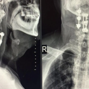 PORTHOS POSTERIOR CERVICAL SPINAL FIXATION SYSTEM - Img 6
