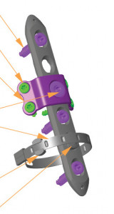 Sirtalis Cerclage System for Periprosthetic Fractures