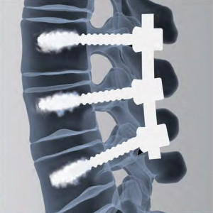 Șuruburi Fenestrate din Titan Vesta – Fixare Vertebrală cu Cimentare pentru Osteoporoză și Oncologie