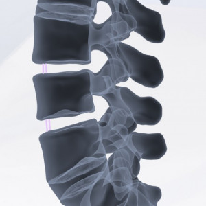 TALOS – Cage TLIF Lombar Posterior din PEEK | Fuziune Intervertebrală Osimplant - Img 2