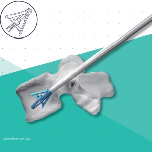 TRIPOD-FIX – Sistem Expandabil Vertebral pentru Fracturi de Compresie | Augmentare cu PMMA