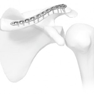 Vortex Clavicle plate with lateral extremity