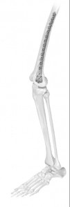 Vortex Distal Femur plate (VDF)