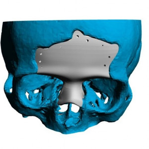 Cranioplasty plate for ENT defects - Img 3