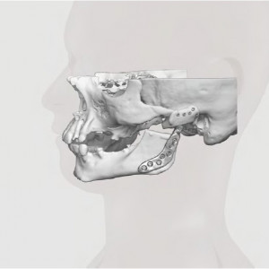 Endoproteză TMJ Specifică Pacientului – Soluție 3D Personalizată Ortho Baltic