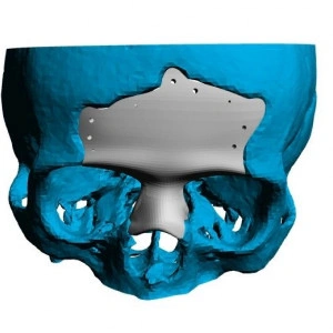 Implant Personalizat pentru Cranioplastie ORL – Soluție 3D Precise de la 3di Germania - Img 3