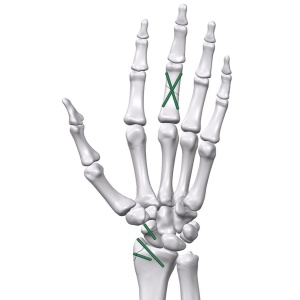 Inion FreedomPin™ – Pin ortopedic bioresorbabil pentru fracturi și osteotomii | Ø1.5–3.2 mm