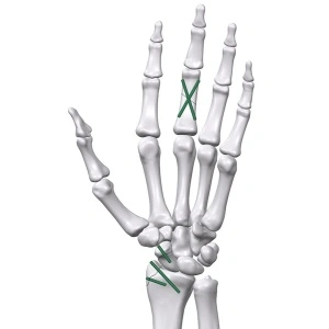 Inion FreedomPin™ – Pin ortopedic bioresorbabil pentru fracturi și osteotomii | Ø1.5–3.2 mm
