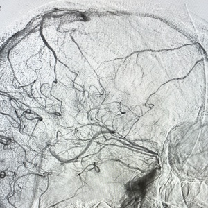 Pictura abstracta: The STROKE ( Accidentul Vascular Cerebral) sau Omul din Copacul Creierului - Img 6