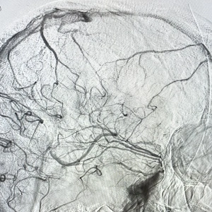 Pictura abstracta: The STROKE ( Accidentul Vascular Cerebral) sau Omul din Copacul Creierului - Img 6