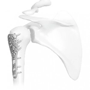 Placă Humerus Proximal– Tratament Fracturi de Cap Humeral | Sistem Vortex Sanatmetal