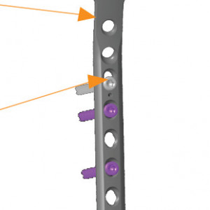 Placa de tibie proximala in T poliaxiala pentru osteosinteza fracturii de tibie Enlife