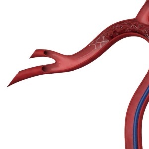 THROMBITE™ – Stent Retriever pentru Trombectomie | Zylox-Tonbridge Medical - Img 2