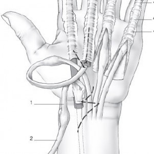 Universal Tendon Spacer U.T.S. – Distanțier Tendinos din Silicon pentru Reconstrucția Tendoanelor Flexorilor și Extensorilor