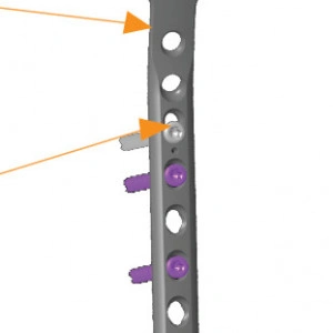 Placa de tibie proximala in T poliaxiala pentru osteosinteza fracturii de tibie Enlife
