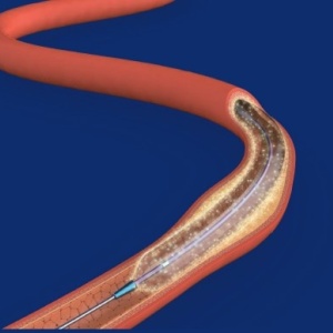 ZENFluxion™ – Balon PTA cu Paclitaxel | Zylox-Tonbridge - Img 2