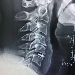 ARION – Cage Cervical Expandabil cu Lame de Fixare | Fuziune Anterioară Cervicală - Img 5