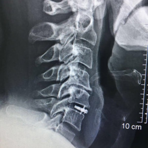ARION EXPANDABLE BLADED CERVICAL PEEK CAGE - Img 5