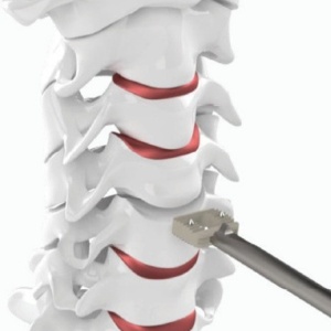 Hernie de Disc Cervicala, Cage Cervical din PEEK Bia