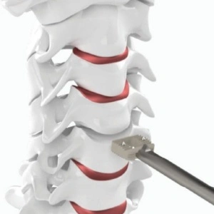 Hernie de Disc Cervicala, Cage Cervical din PEEK Bia