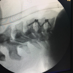 Cage Cervical TitanoPEEK-C cu suruburi de prindere si profil anatomic - Img 5