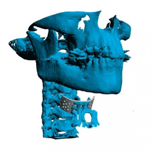 Cranioplasty plate for ENT defects