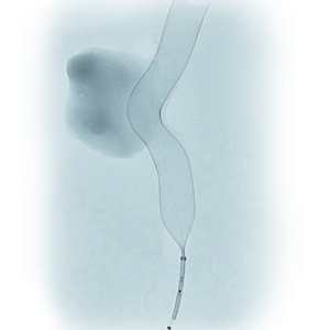 Dispozitiv de embolizare pentru tratamentul anevrismelor cerebrale - DERIVO® 2 - Img 3