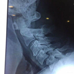 EOS BLADED CERVICAL PEEK CAGE - Img 3