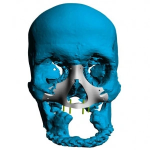 Implant personalizat pentru reconstructia fetei si craniului | 3di Germania - Img 5