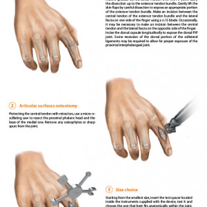 Implant interfalangian PIP din silicon( Chirurgie Plastica, Ortopedie)