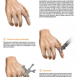 Implant interfalangian PIP din silicon( Chirurgie Plastica, Ortopedie)