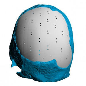 Placa (Cranioplastie), defecte craniene - Img 2