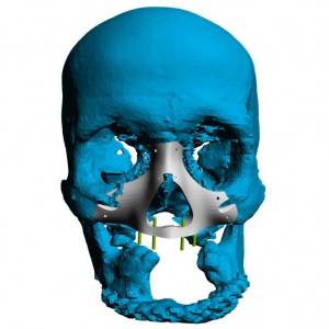 Placă Cranioplastie Personalizată 3D – Implant pentru Defecte BMF | 3di Germania - Img 5