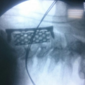 SENTINUS CORPECTOMY MESH CAGES - Img 2